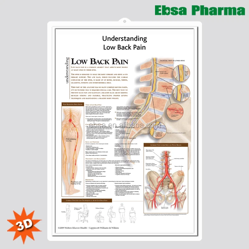 3D Medical Human Anatomy Wall Charts / Poster - Understanding Low Back Pain