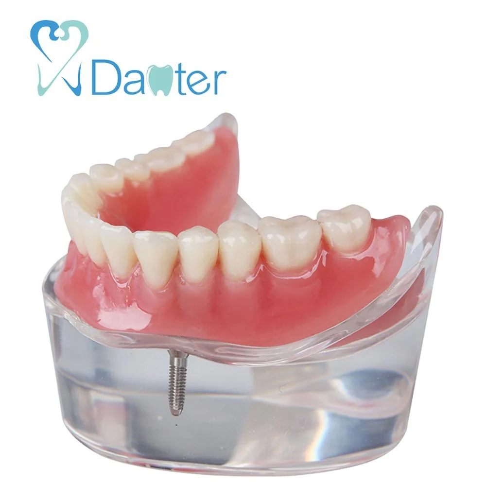 high quality overdenture model with 2 implants