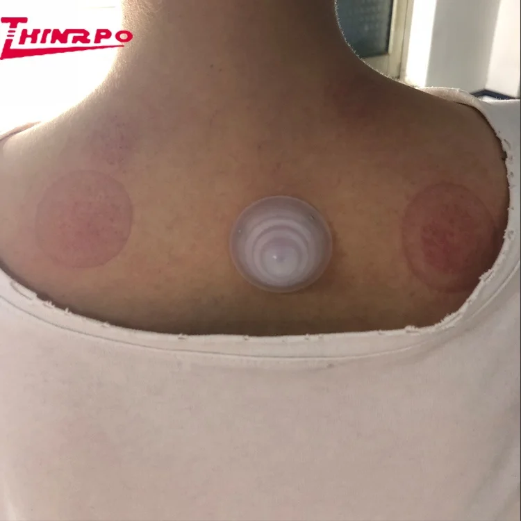 Custom Mold Traditional Chinese Medical Silicone Massage Cupping
