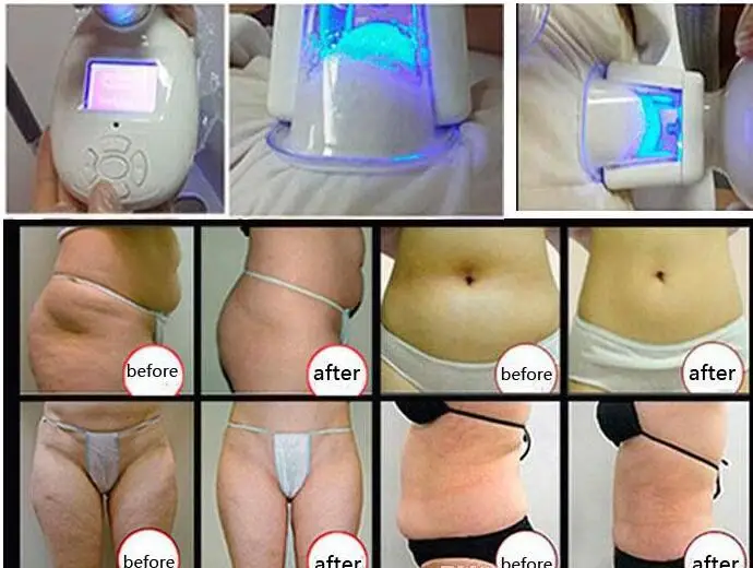 2 Cryo Handle Fat Freeze Belt Vacuum Lipo Cavitation RF Laser Slim Machine