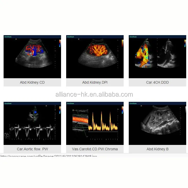 Sonoscape S6 Portable 4D Color Doppler Ultrasound For Human