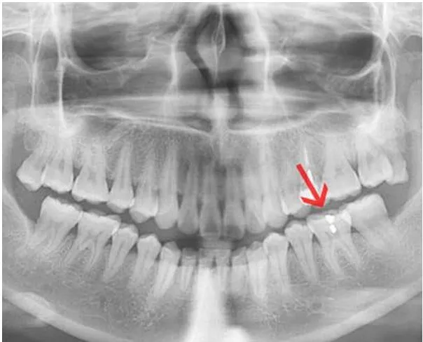 Agfa x-ray film 14*17 / Konica Sdq Dry Laser Medical X-Ray Film Sd-Q