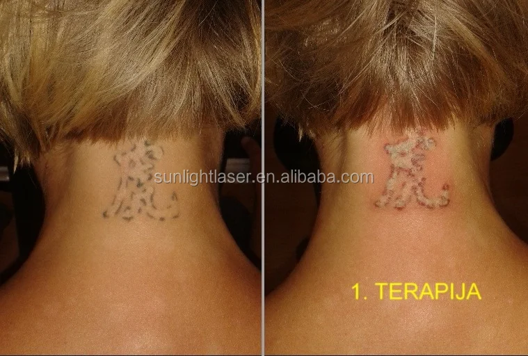
More Effective tattoo removal laser equipment 