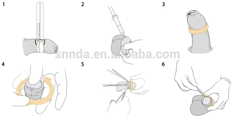 The Shang Ring instrument for simplified adult circumcision