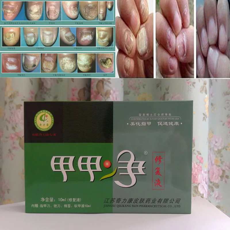 2016 Limited Nail Fungus For Nails Polish To Remove Armor Onychomycosis Sterilization Repair Nursing Of Problem
