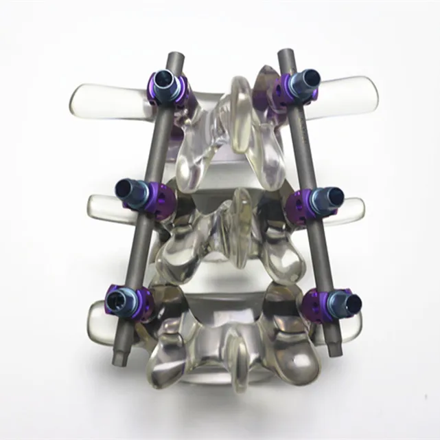 
Titanium alloy spinal fixation and anterior cervical plating system  (60832314676)