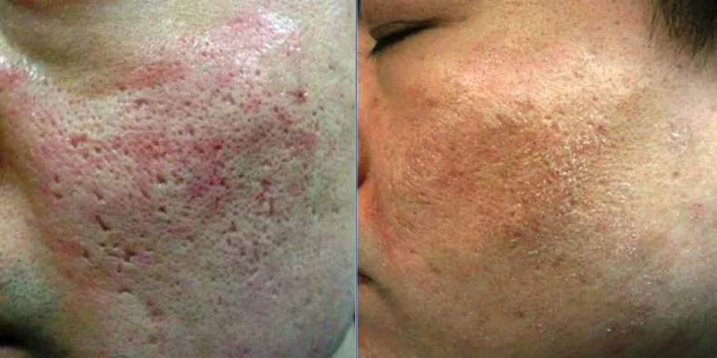 China Professional Supplier fractional rf microneedle machine for stretch mark acne wrinkle removal