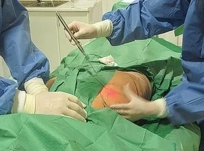 laser liposuction surgery mini-invasive laser surgery melting fat slimming lipolysis laser