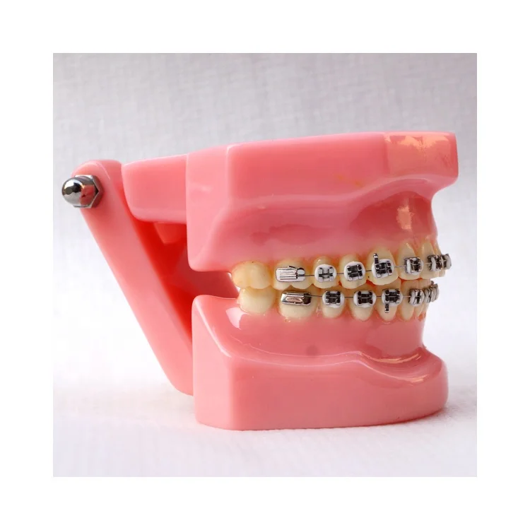 Dental Orthodontic model With metal brackets