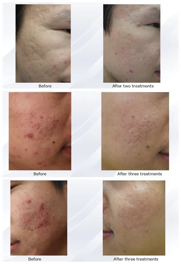 GSD 1550nm erbium glass optical fiber laser tatoo removal(GSD Renas)
