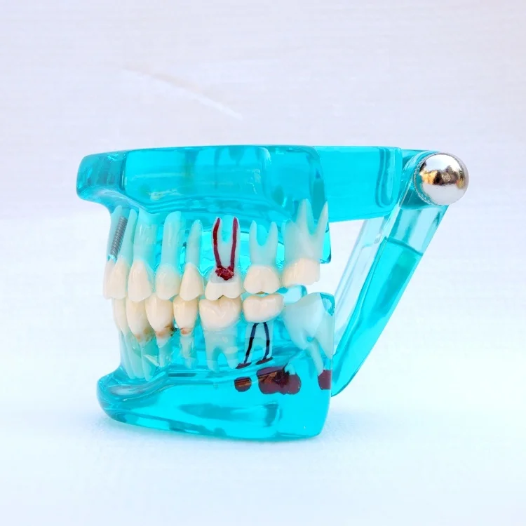 Tooth Restoration model with Implant