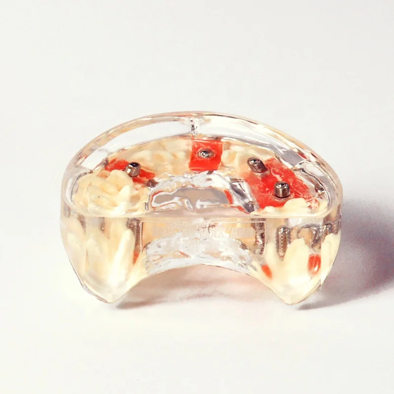 Демонстрационная модель имплантации с одной короной и мостом