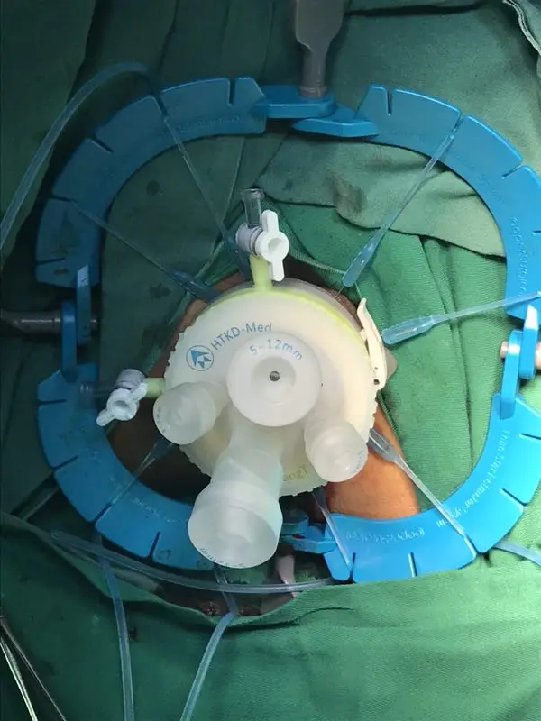 CE approved  Single Port  hospital medical surgical instruments for laparoscopic operation