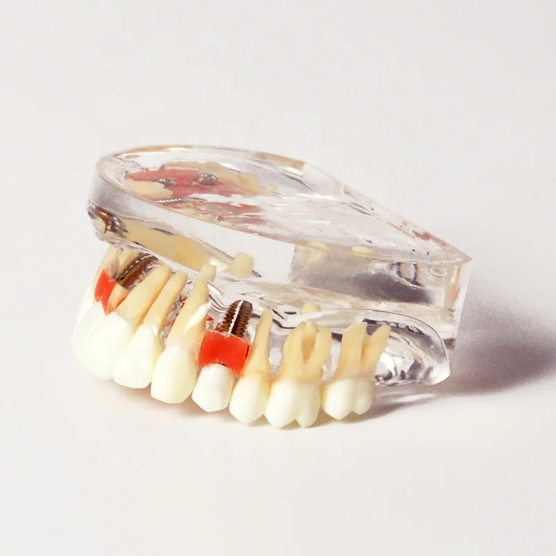 Демонстрационная модель имплантации с одной короной и мостом