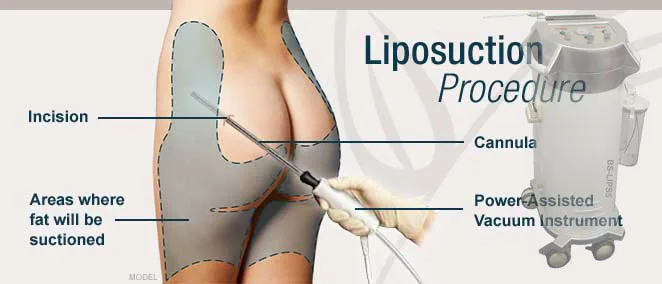 Laser Liposuction Fat Removal Machine SmartLipo For Plastic Surgery Hospital