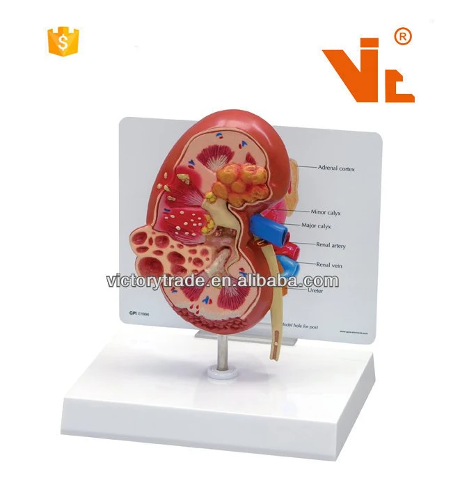 V-AM035 Plastic  Anatomy Human Organs Kidney Cyst Model