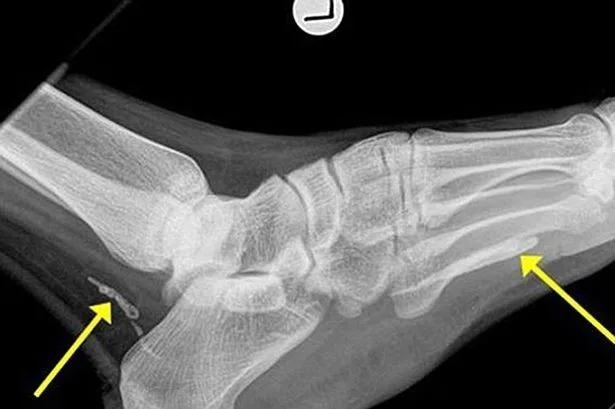 Agfa x-ray film 14*17 / Konica Sdq Dry Laser Medical X-Ray Film Sd-Q