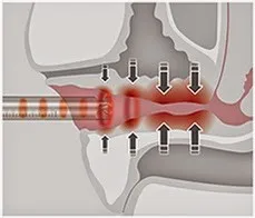 2016 новые лазеры для хирургии и медицины оборудование омоложения жидкости