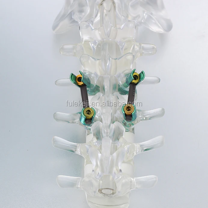 5.5 spinal screw system adjustable connector orthopedic implant spinal implant