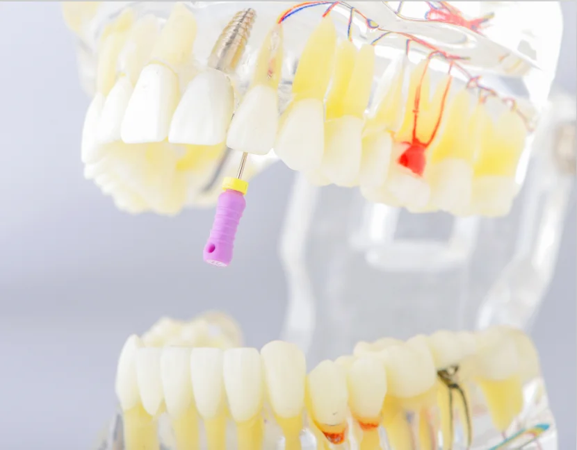 Adult pathological dental model with missing tooth caries apical cyst, tartar ,implant etc