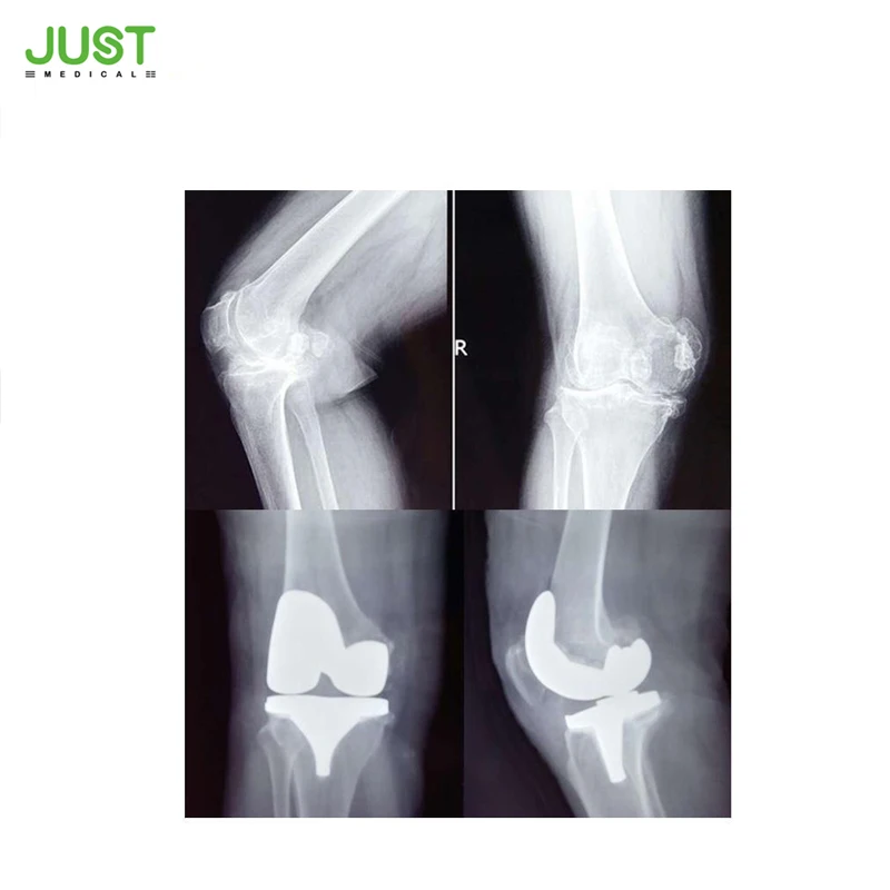 
Good quality and best price Knee prosthesis Primary knee joint prosthesis from China manufacturer 