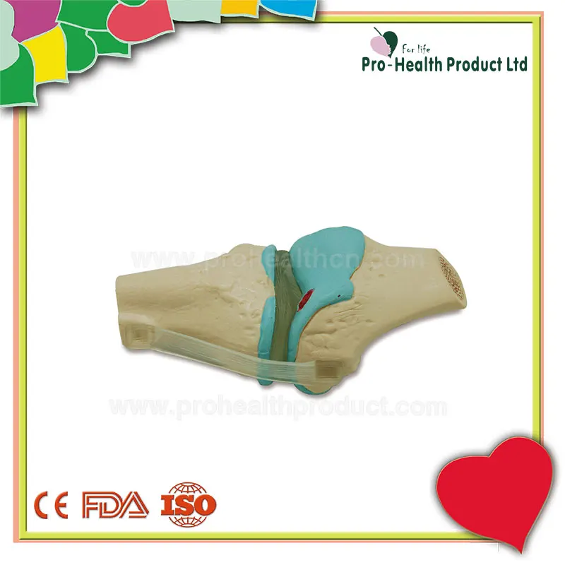 Joint Disease Knee Lesions Arthritis Knee Osteoarthritis Model Four Stage Degenerative