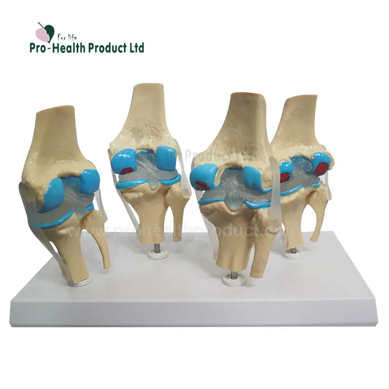 Joint Disease Knee Lesions Arthritis Knee Osteoarthritis Model Four Stage Degenerative