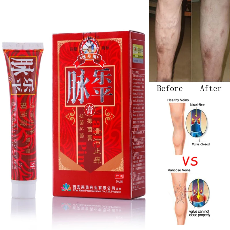 
2018 Hot selling Varicose veins ointment vascular removal spider vein treatment cream natural 