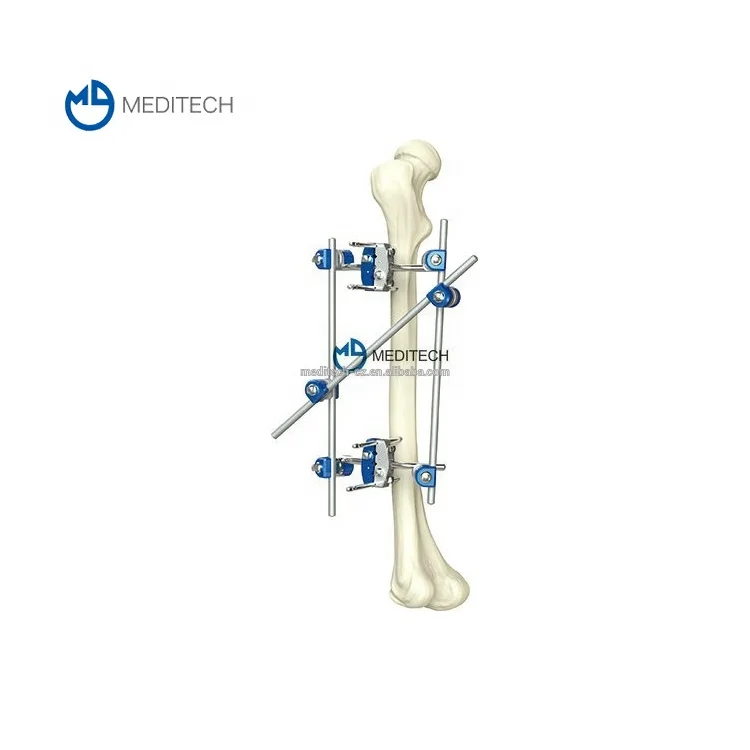 Sell well proximal tibia fragment surgical instrument external fixator