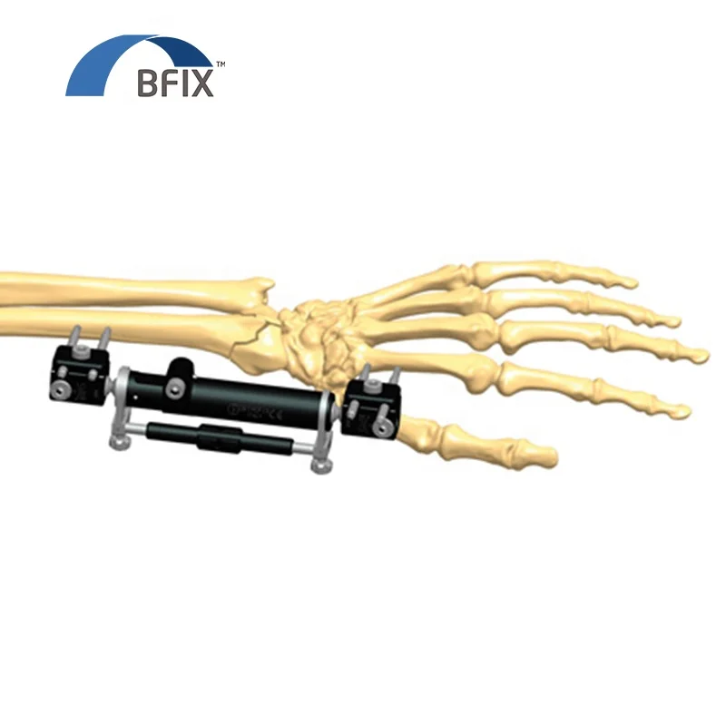 
Unstable, intra-articular distal radius fracture , Radiolucent wrist fixator 
