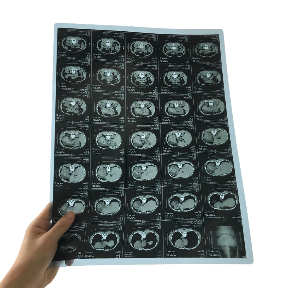 Inkjet medical x-ray film 11*14 inch for HD dicom printer