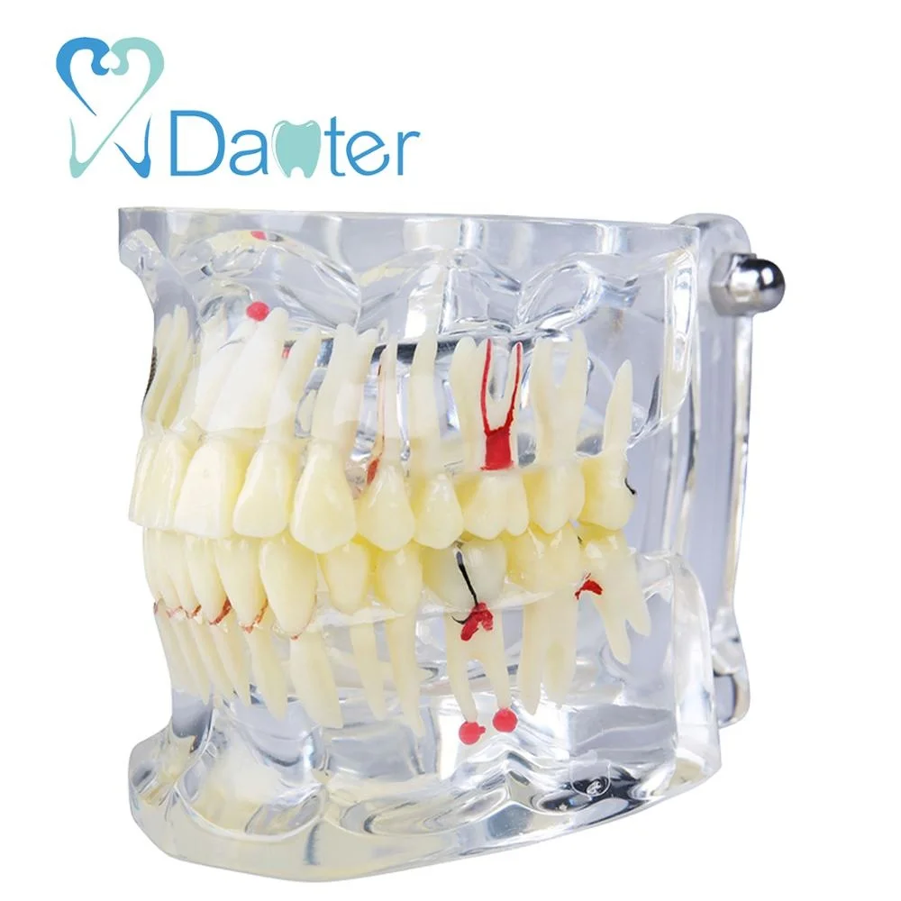 Adult Dental Pathologies Teeth Model with Missing Teeth for showing caries apical cyst tartar implant impaction missing teeth