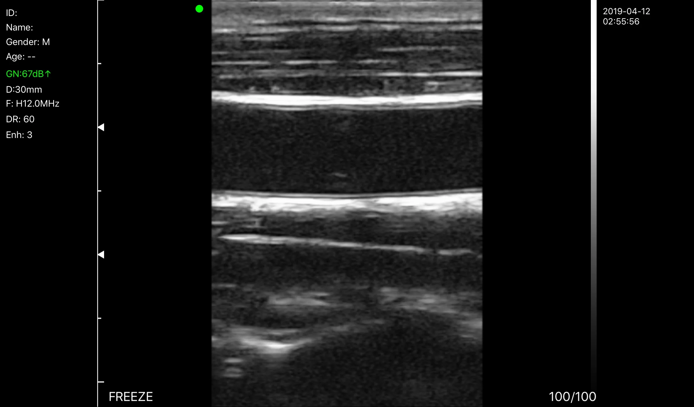 Medical Vein Finder musculoskeletal ultrasound Scanning ultrasonic machine