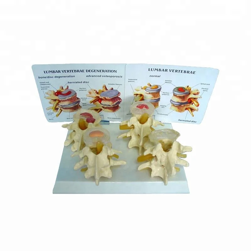 4 Pcs Vertebrae Nomorl Diseaser Composition Model