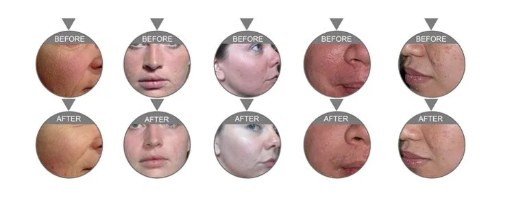 5 in1 oxygen aqua jet peel water microdermabrasion facial machine