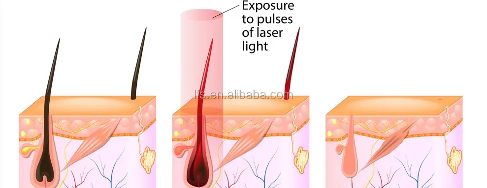 LFS-A9 портативный shr машины цены SHR/OPT/AFT IPL + elight + RF Многофункциональный IPL SHR