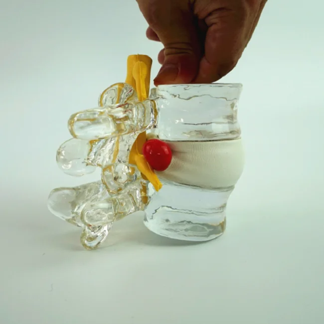 R020935 Crystal Transparent Vertebral Simulator, Lumbar Disc Herniation Model