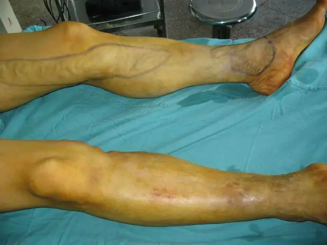 15w 1470nm diode laser for great saphenous vein varicosities treatment