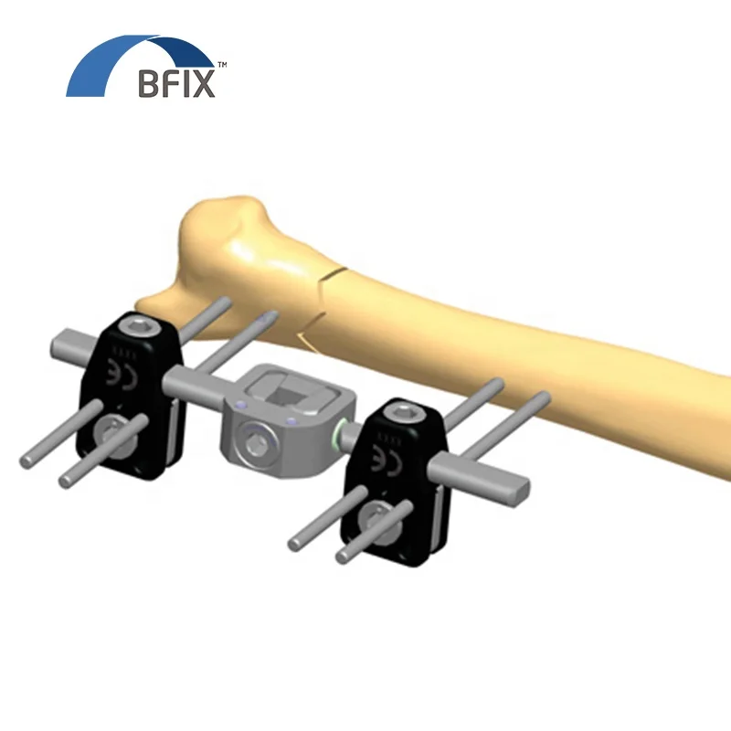 Orthpedic Mini Fixator Application in Extra-articular fracture of distal ulna