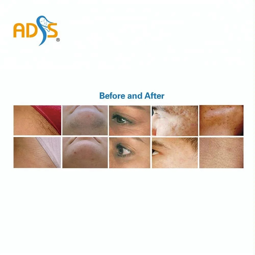 IPL+RF hair removal unhairing skin rejuvenation laser machine