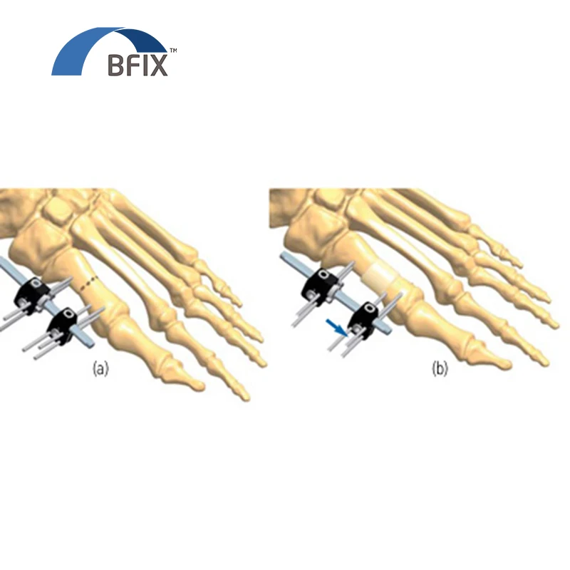 Orthpedic Mini Fixator Application in Extra-articular fracture of distal ulna
