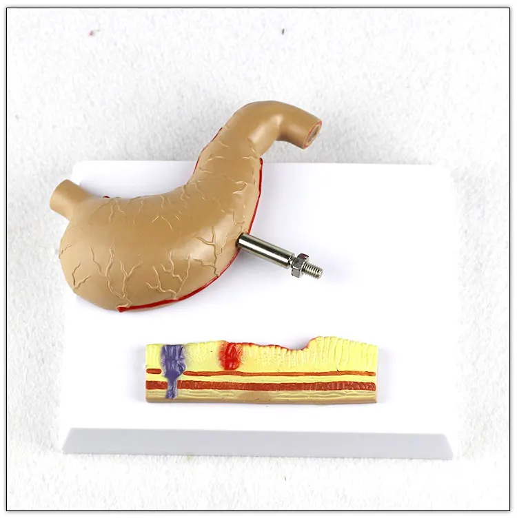 Stomach-Pathological gastric ulcer  Human Digestive System Medical Teaching Anatomical Model visceral model