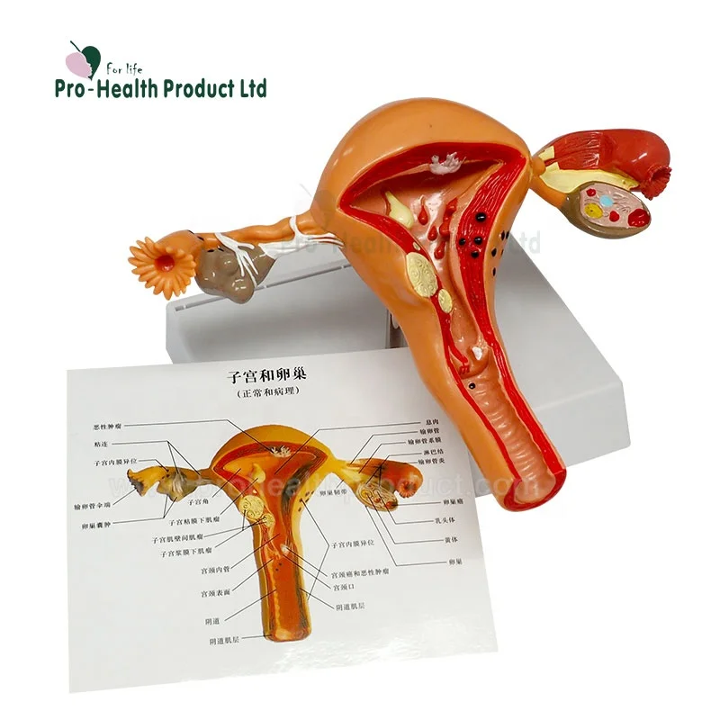 Female Pathological 3D Plastic Uterus Ovary Anatomical Model