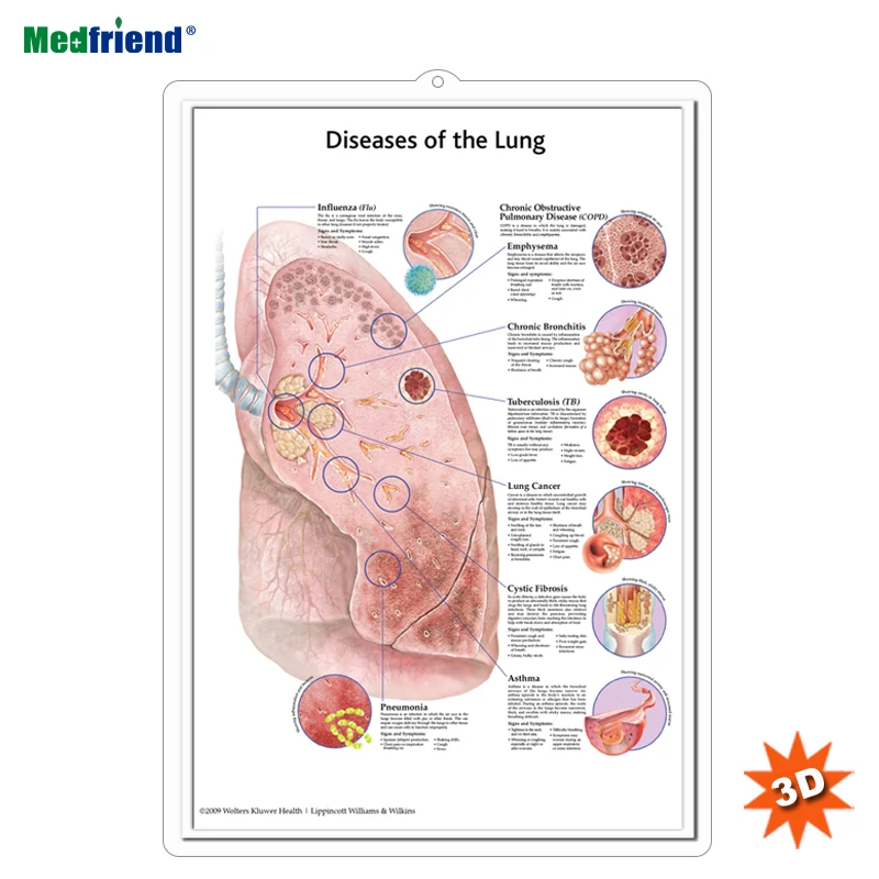
Licensed Educational Plastic 3D Medical Anatomical Wall Chart /Poster - Diseases of the Lung 