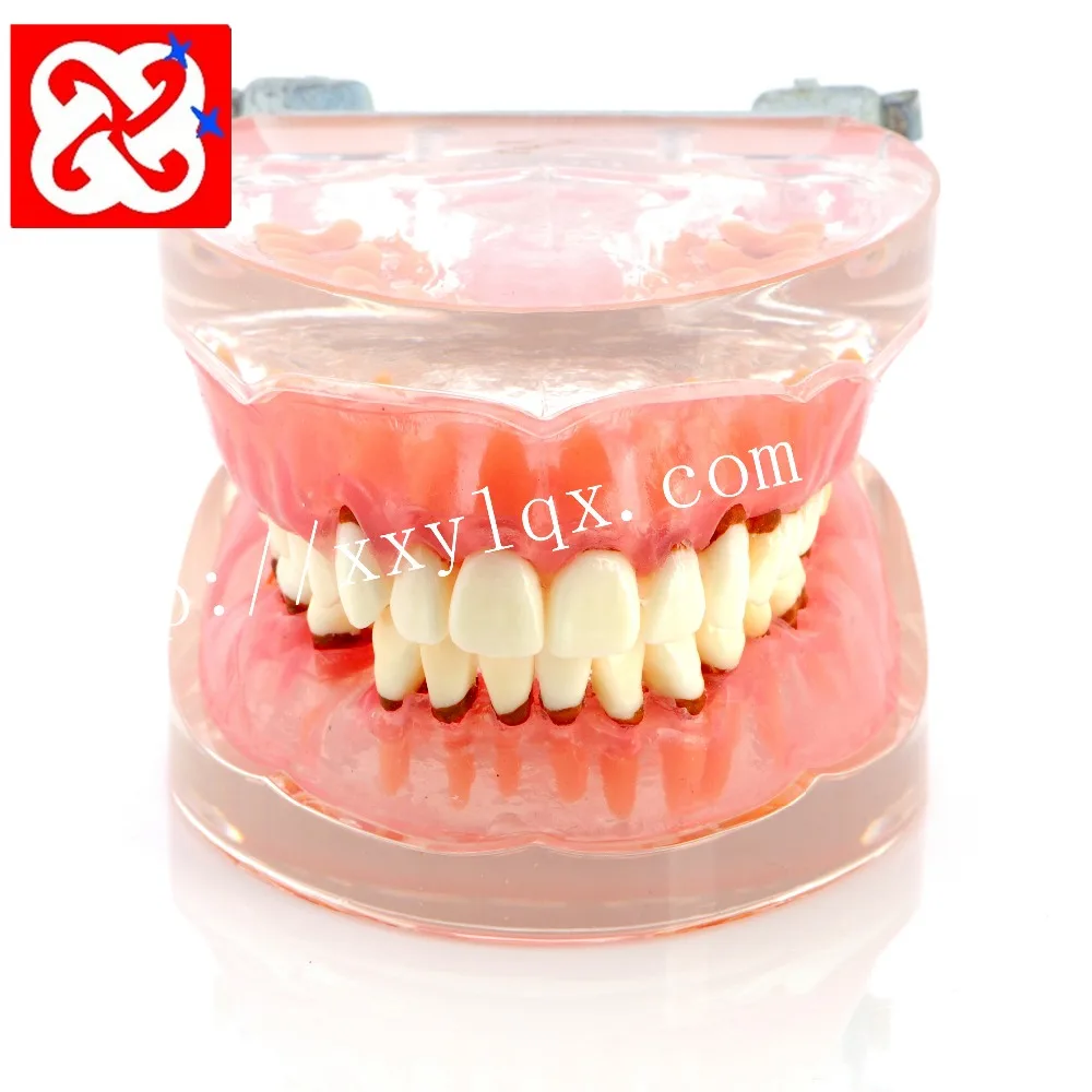 Модель периодонтальной демурации с калькулясом, ресией гингиви, сменной гингивай