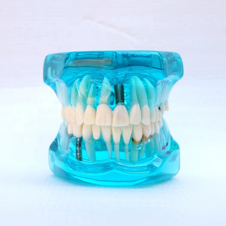 Tooth Restoration model with Implant