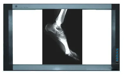 
film viewer LED light box medical agfa x ray blue film 