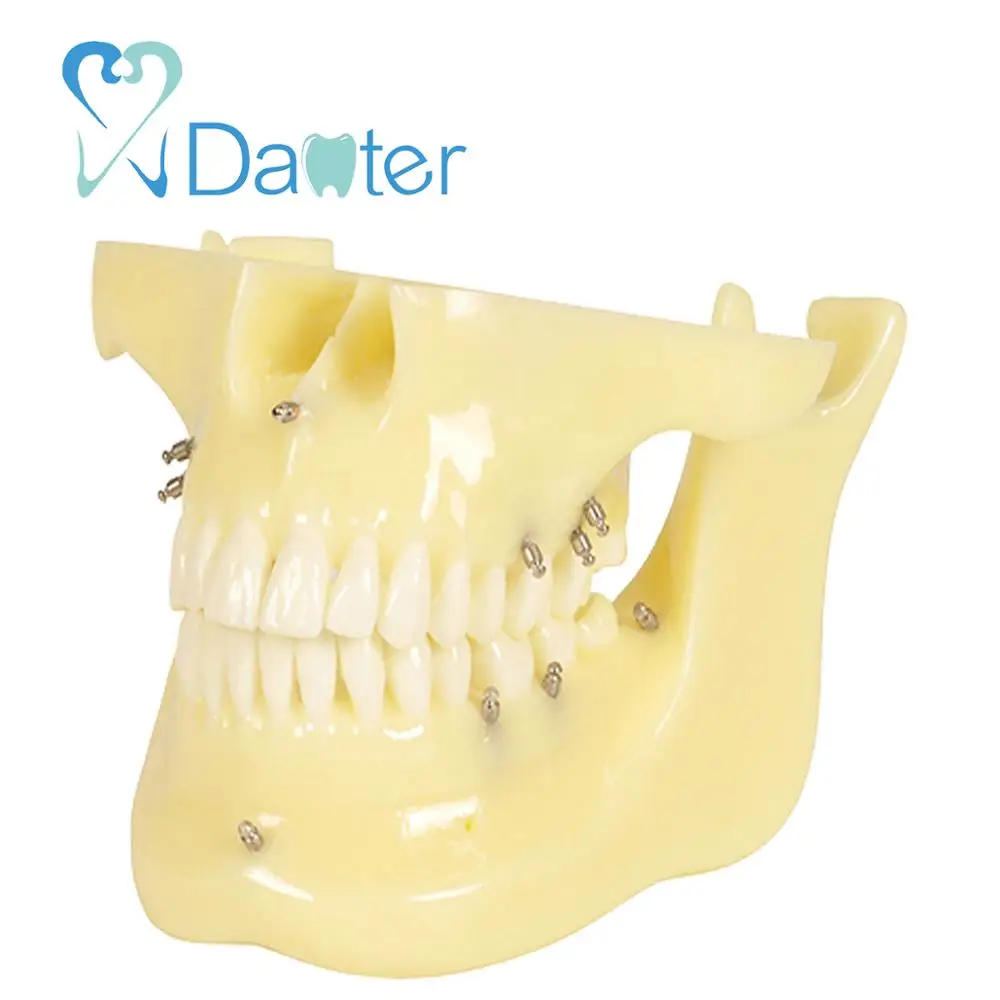 China Dental Implants Dental Orthodontic Model with Ortho Implant