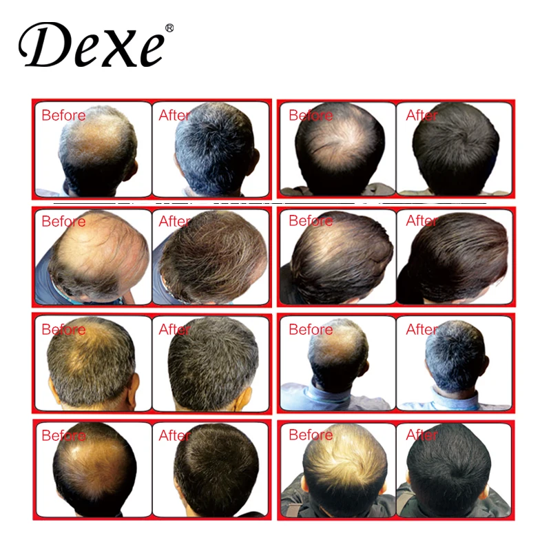 Oem/odm Dexe Anti Hair Loss Lotion Wholesale Best Herbal Grow Hair Lotion Buy Anti Hair Loss Lotion