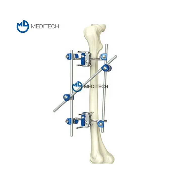 Sell well proximal tibia fragment surgical instrument external fixator